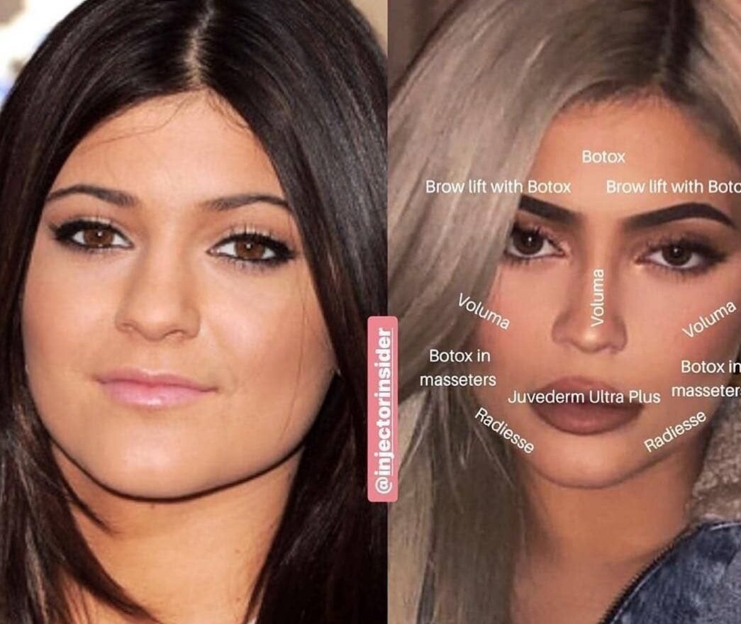 Кайли Дженнер , яркий представитель "улучшайзинга" , многие не воспринимают, однако, в инстаграме следят 150 млн 