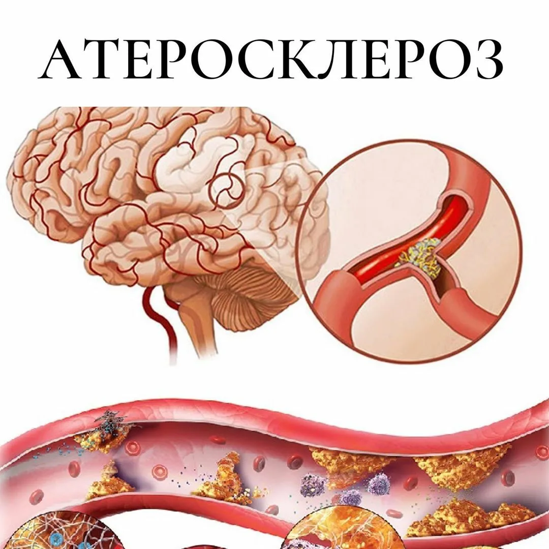 Атеросклероз анатомия. Атеросклероз артерий головного мозга. Атеросклероз бляшки сосудов. Атеросклероз сосудов головного мозга симптомы. Атеросклероз церебральных сосудов симптомы.