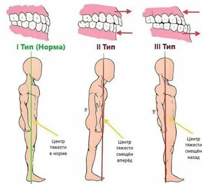 При неправильном прикусе организм пытается уравновесить положение тела в пространстве за счет изменения положения головы и позвоночника. Фото: Яндекс.Картинки.