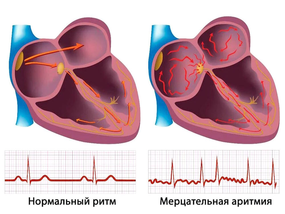 Аритмия сердца: симптомы, причины и лечение - полезные статьи