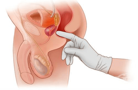 Пальцевой массаж простаты