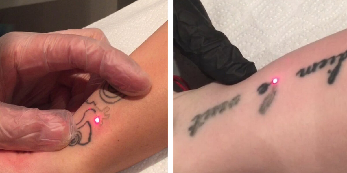 Первичная реакция кожи на лазер.