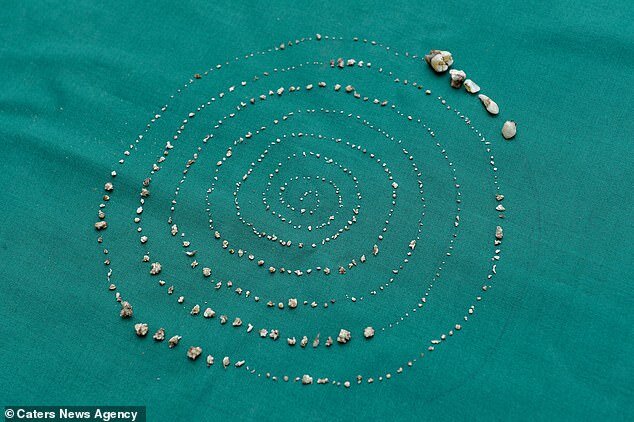 526 кусочков зубов из челюсти 7-летнего пациента. Фото Daily Mail.