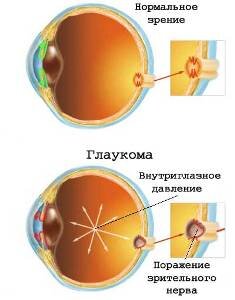 Кому грозит возрастная глаукома?