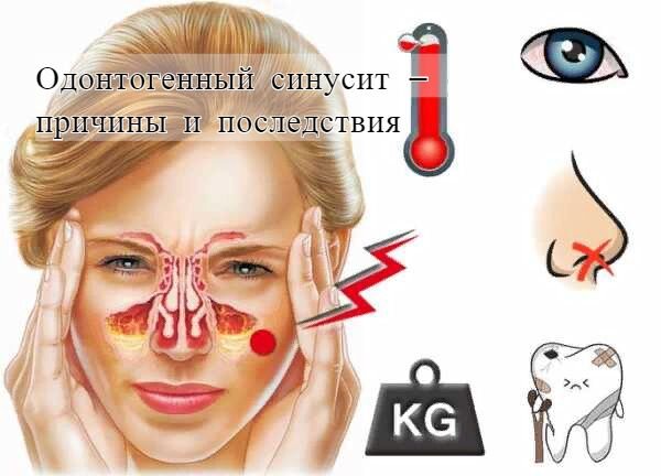 Одонтогенный гайморит.