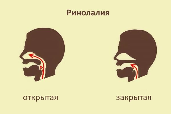 Ринолалия картинки для презентации