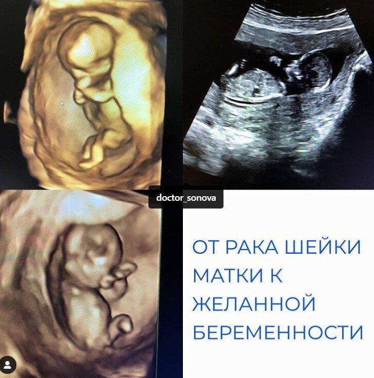 От рака шейки матки к желанной беременности.
