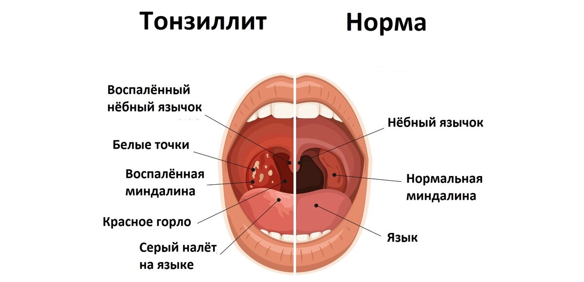 Воспалительный процесс протекает вяло. Иногда человек даже не предполагает, что болен. Просто страдает от ставшего привычным лёгкого недомогания и считает горло своим слабым местом: чуть ветерок — сразу болит.