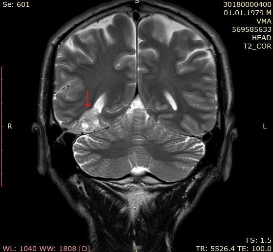 На снимке видно, что опухоль не контактирует с мозжечком, но тесно прилегает к полости рога правого бокового желудочка.