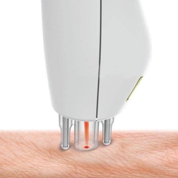 Бытовые лазерные эпиляторы очень ограничены в площади своего действия, многие модели за вспышку удаляют только 1 волосок