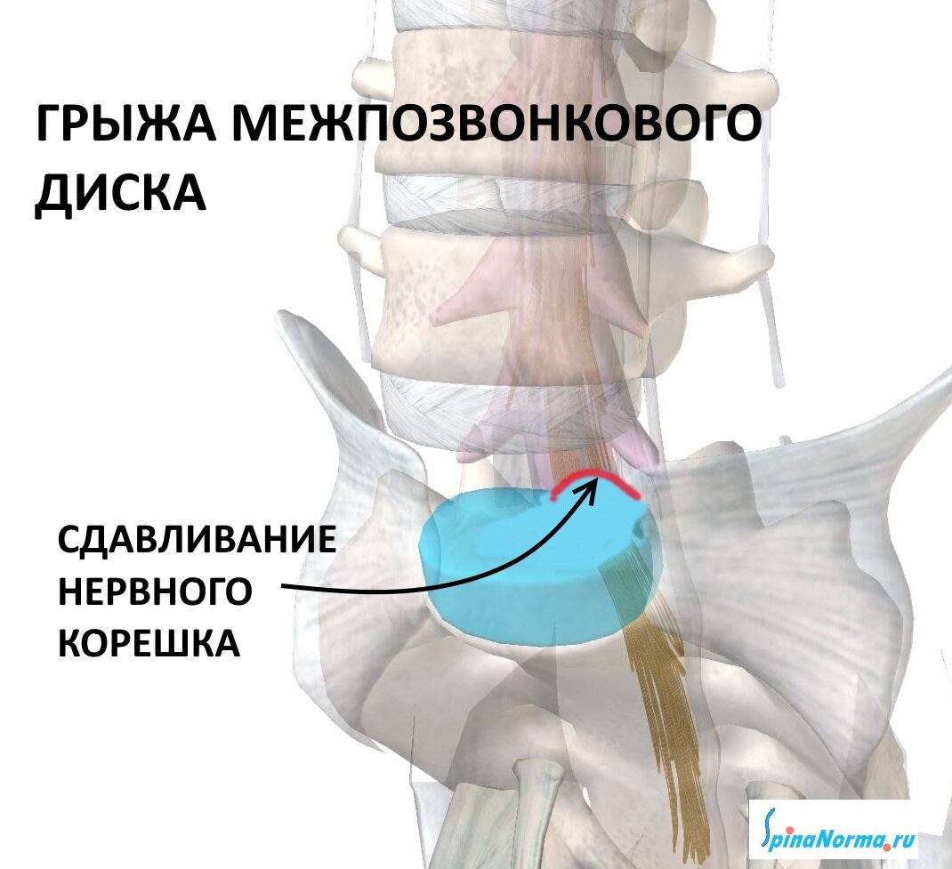 Синдром конского хвоста у человека симптомы лечение фото