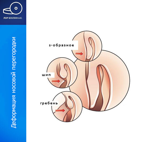 Виды деформации носовой перегородки. Боклин А.К. (изображение с моего сайта: boklin.ru)
