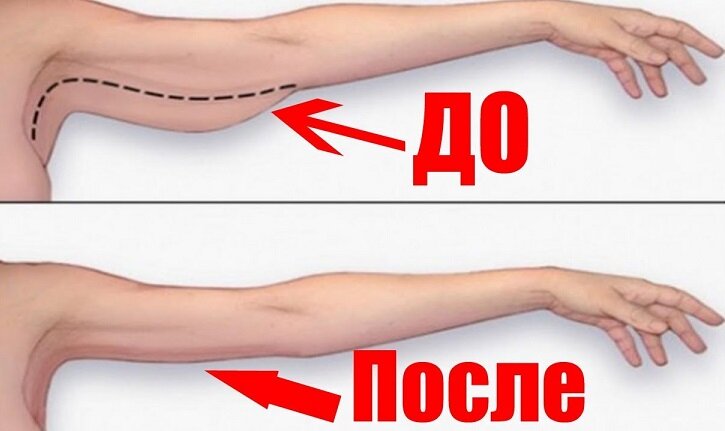 Как подтянуть кожу после похудения