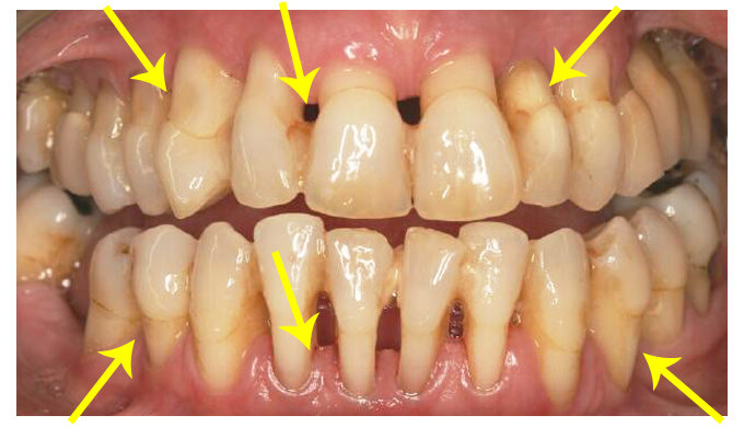 Клиническое проявление при пародонтозе. Жёлтыми указателями указана убыль костной ткани и бледная окраска десны, отсутствие видимых зубных отложений.