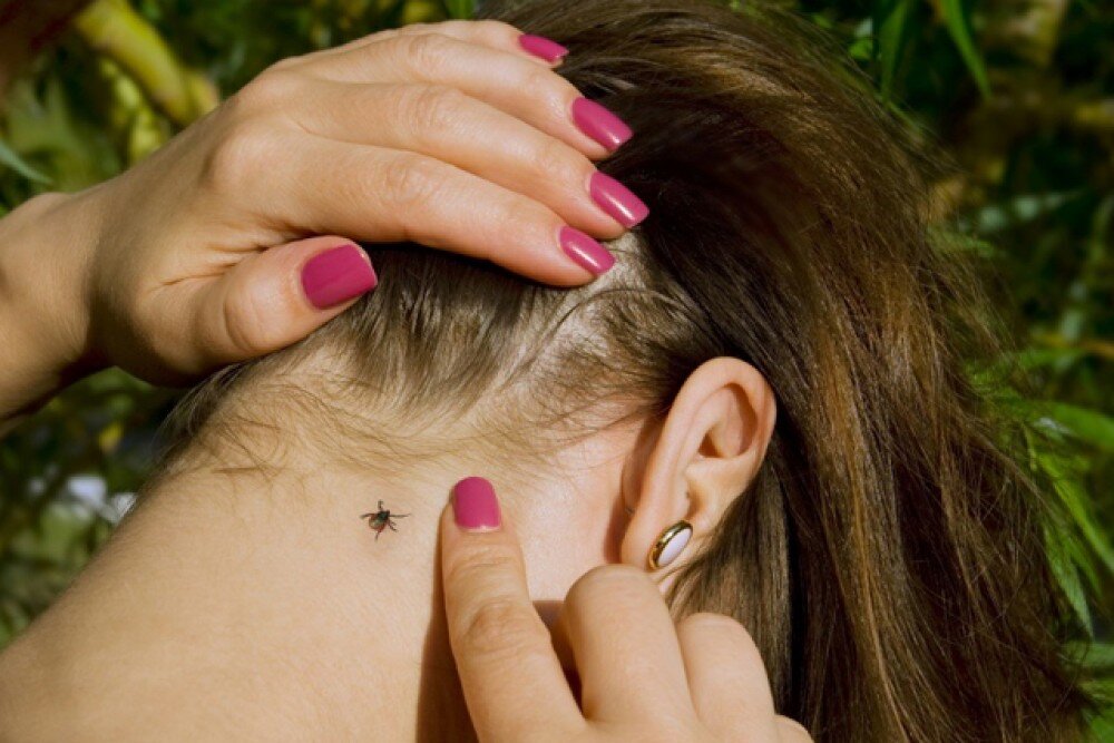 Клещ у ребенка. Источник dezborets.ru