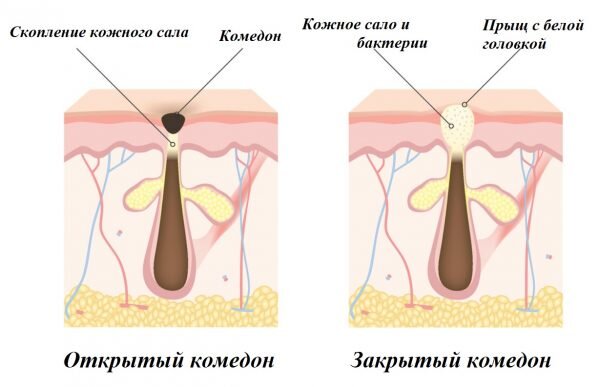Чёрные точки — это начальная стадия угрей, относительно легко поддающаяся лечению