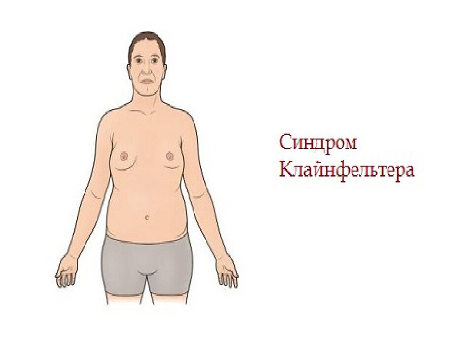 Клиническая картина синдрома клайнфельтера