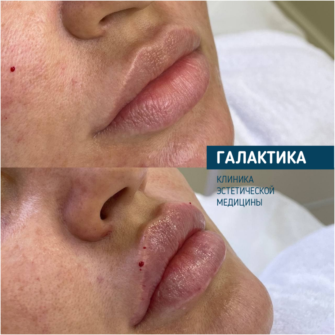 Работа Ольги Дагиевны Миргазовой - врача-косметолога Клиники "Галактика"