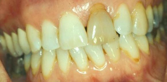 Я подумал - сегодня зубы, а завтра что? Сердце, легкие … но их-то новые не вставишь! Вообщем, на этот раз я бросил основательно. То есть, аж на два месяца. Вам смешно, а для меня это стало рекордом. И худшими 60 днями жизни.