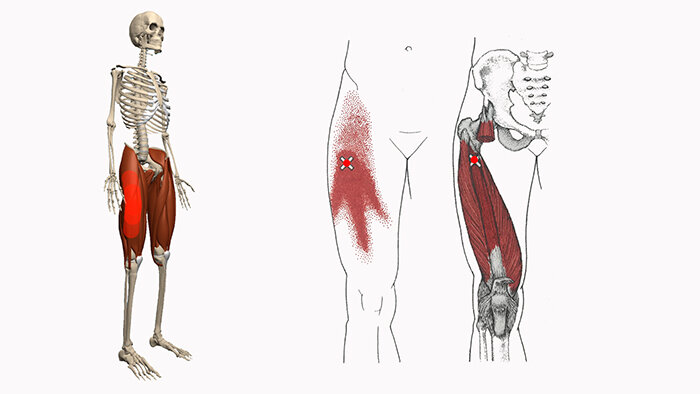 Триггерные мышцы бедра