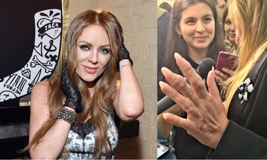 началова подагра. подагра певица юлия началова. певица с подагрой на руках. юлия началова перед смертью. молодая певица умершая от подагры.