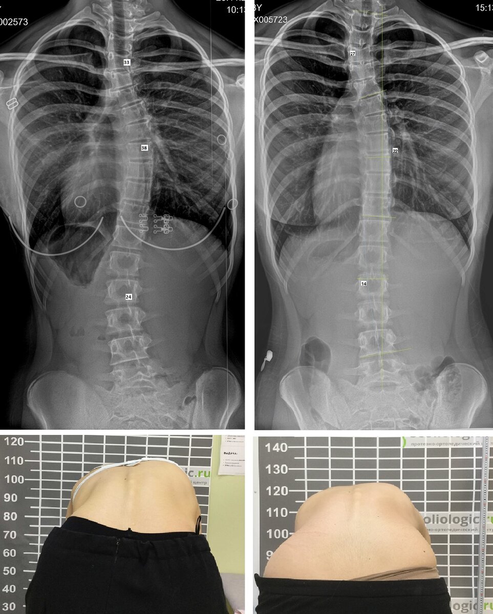 Сколиоз 18 градусов фото