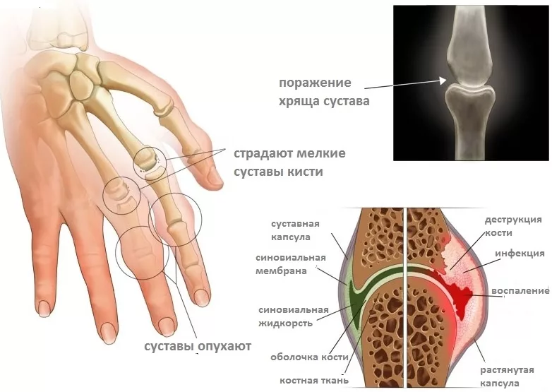 Воспалительное заболевание суставов. Ревматоидный артрит поражение суставов. Ювенильный ревматоидный артрит. Симптомы поражения суставов ревматоидного артрита. Узелки Гебердена ревматоидный артрит