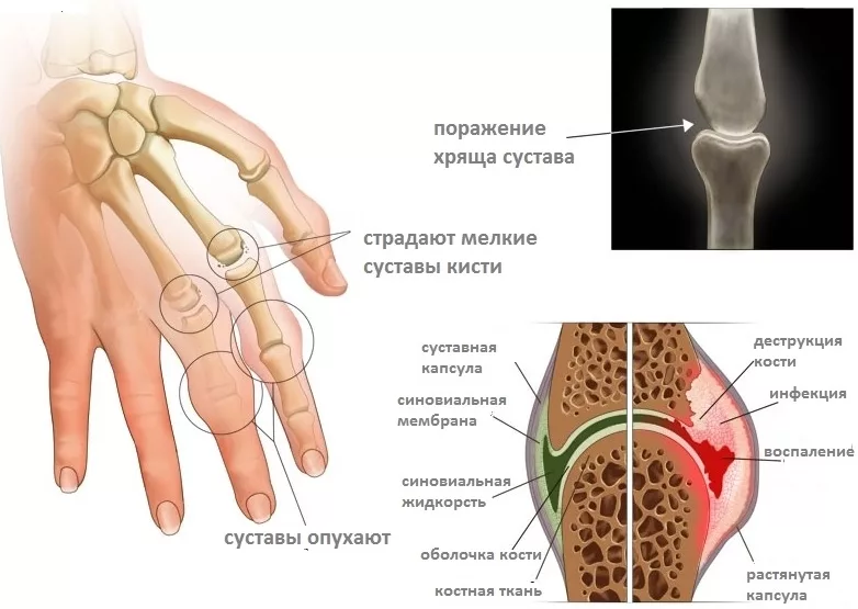 Почему болят суставы и что при этом нужно делать - сосудистая клиника на Патриарших