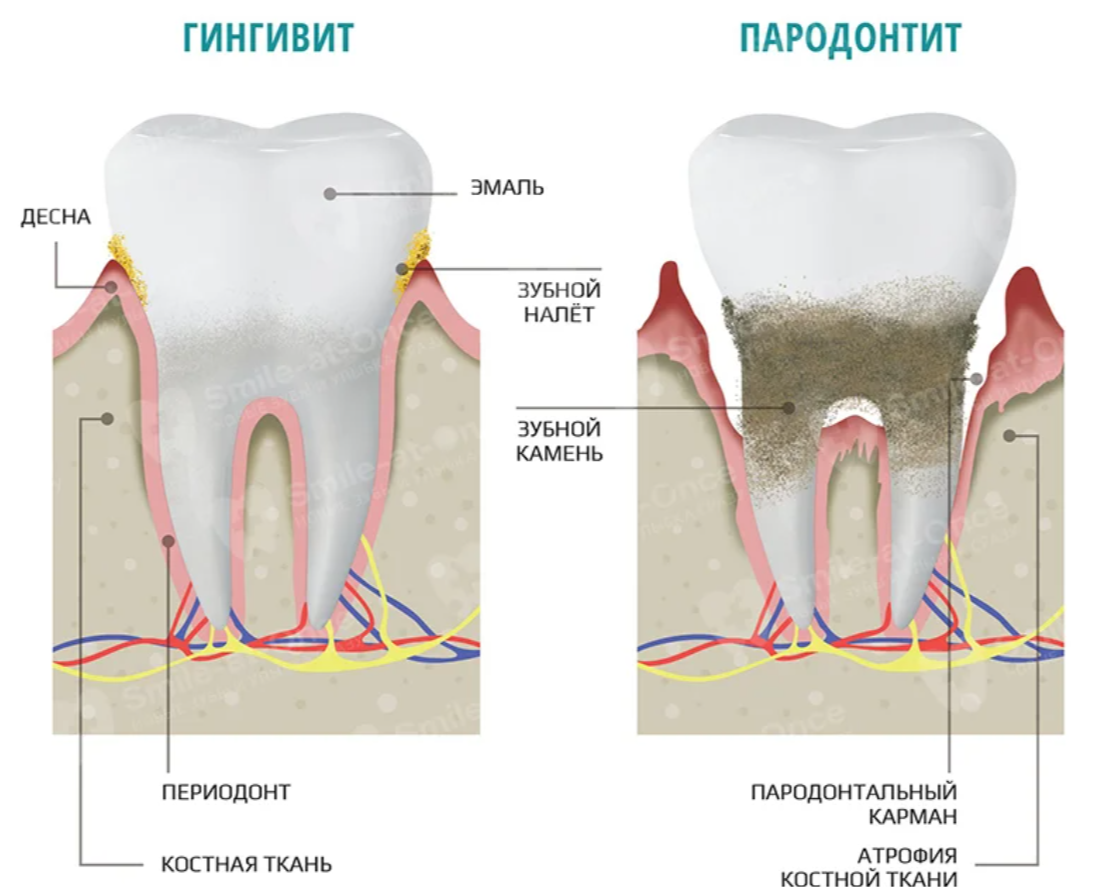 ТОП-5 ошибок, которые вы совершаете, если есть проблемы с деснами |  Стоматология Smile-at-Once | Дзен