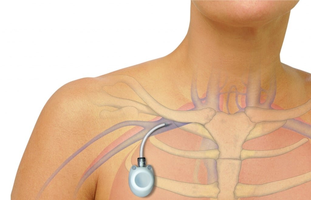 Установка порт системы для проведения химиотерапии (ПХТ) | Медицинский ...