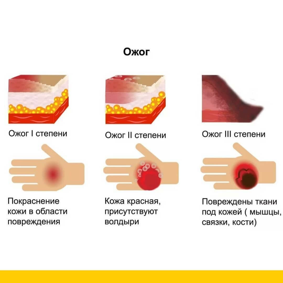 ПЕРВАЯ ПОМОЩЬ ПРИ ОЖОГАХ | ДЕТСКАЯ КЛИНИКА ПЛЮС | Дзен