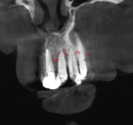 Тяжёлая степень пародонтита.