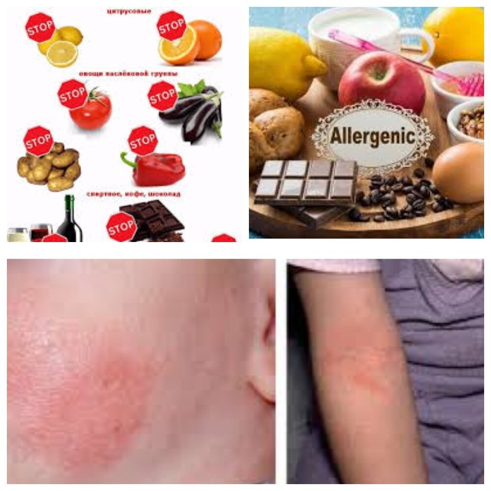 Нейродермит — это заболевание кожи, которое развивается из-за расстройства деятельности нервной системы. Оно может носить хронический характер, а может аллергический. Характеризуется высыпаниями и зудом.