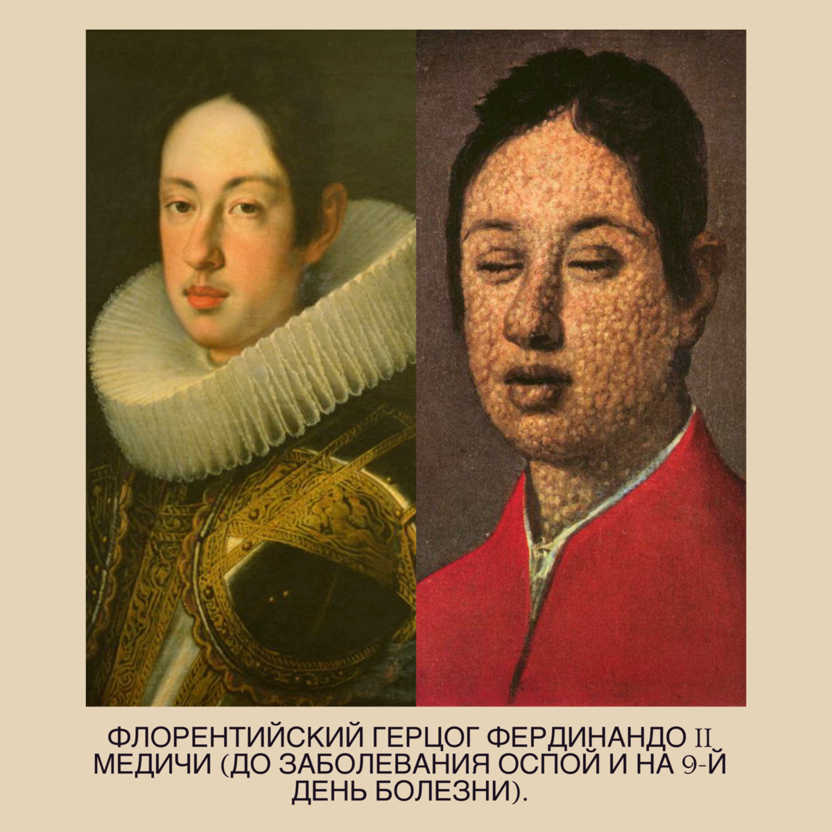Фердинандо 2 Медичи оспа