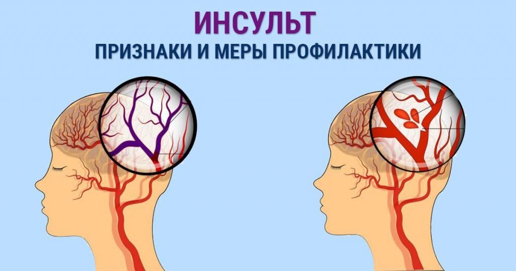 Миф: Все люди, храпящие, подвержены риску инсульта