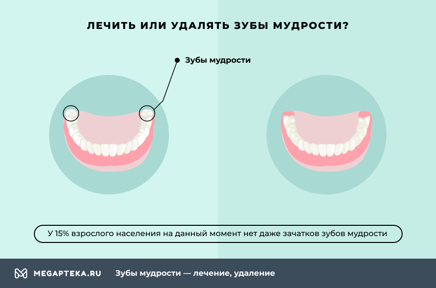Почему удалена. После удаления зуба мудрости. Удалили зуб мудрости рекомендации. Удаление зуба мудрости схема. После вырывания зубов мудрости
