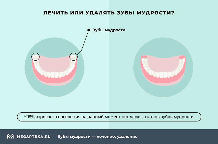 Через сколько удалят. После удаления зуба мудрости. Удалили зуб мудрости рекомендации. Удаление зуба мудрости схема. После вырывания зубов мудрости.