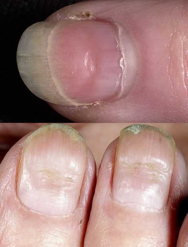 Сухая кожа вокруг ногтя: как вылечить