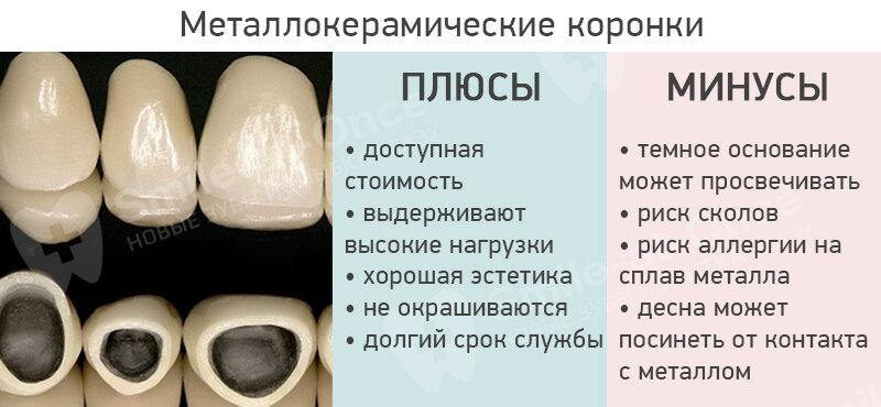 Зубы передние фото коронки какие бывают
