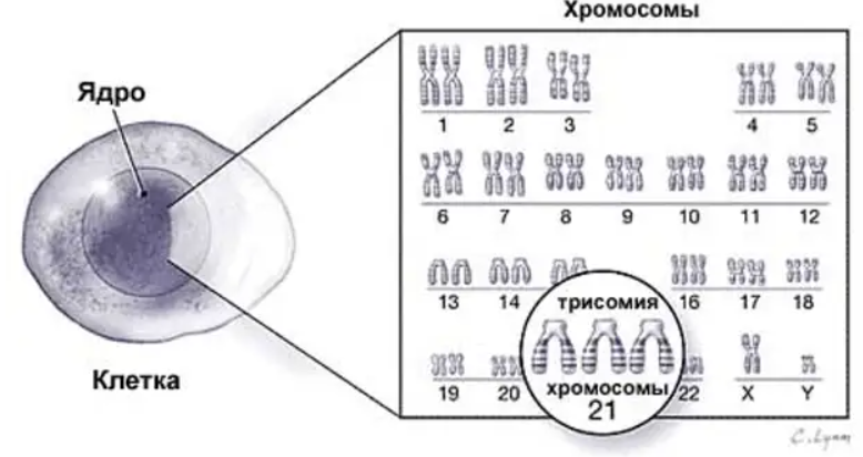 Синдром Дауна и расстройство аутистического спектра