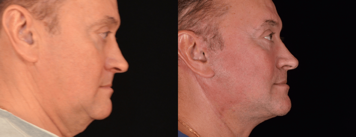 Подтяжка шеи (платизмопластика) фото до и после. Фото с сайта Д.Р. Гришкяна. Имеются противопоказания, требуется консультация специалиста