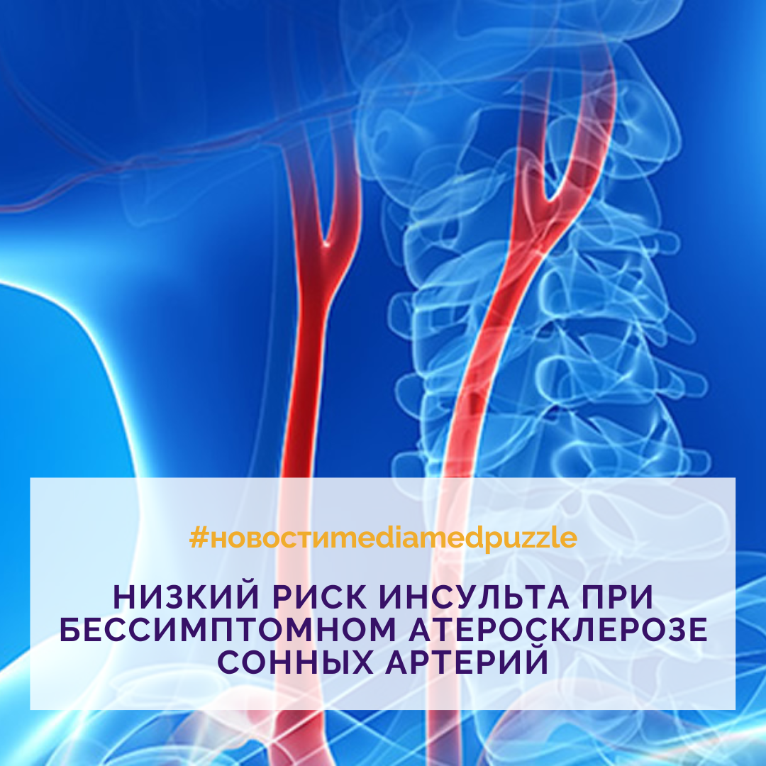 Медиа артерии. Лекарство от атеросклероза сонных артерий в виде тим до 1,1мм.