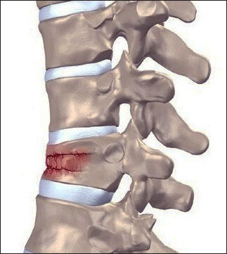 Компрессионный перелом поясничного отдела позвоночника