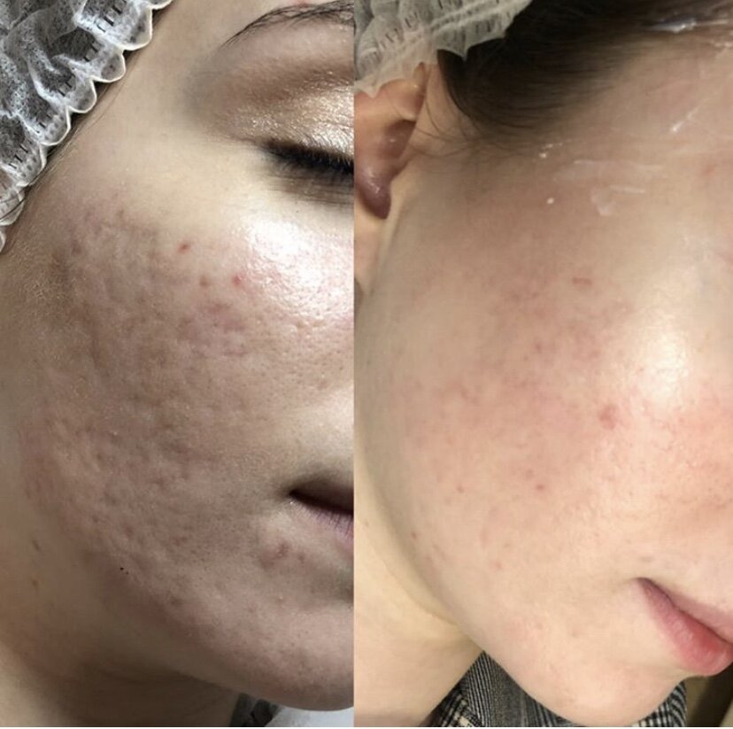 На фото до/после виден результат всего после одной процедуры PRX-T33 с мезороллером. 