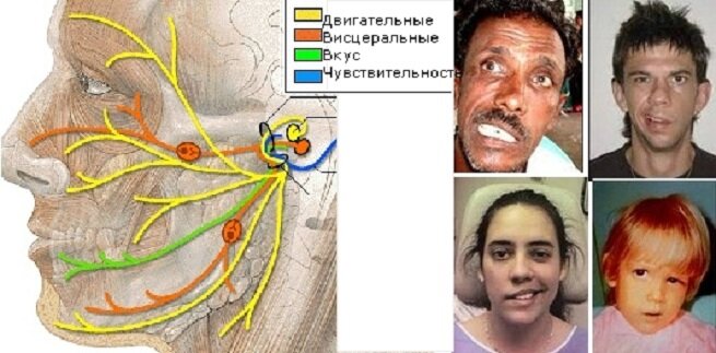 Воспаление тройничного нерва на лице фото