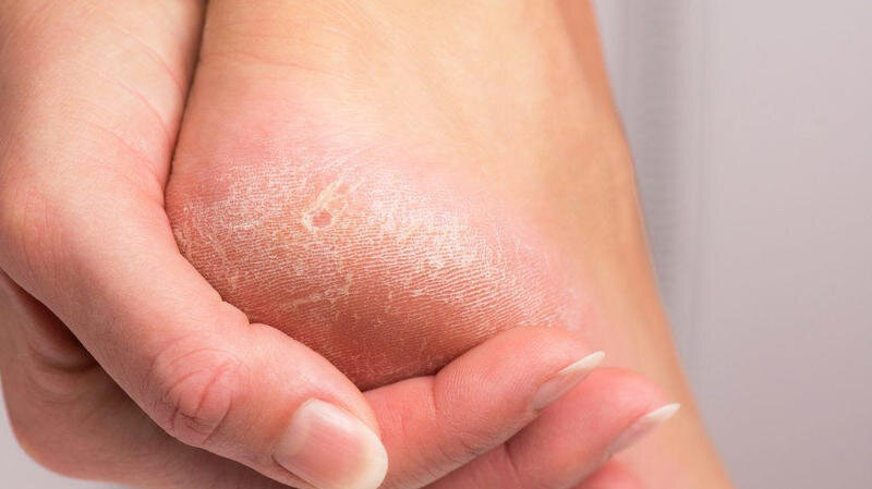 Сухая кожа ног: причины,симптомы и методы увлажнения | Бепантен®