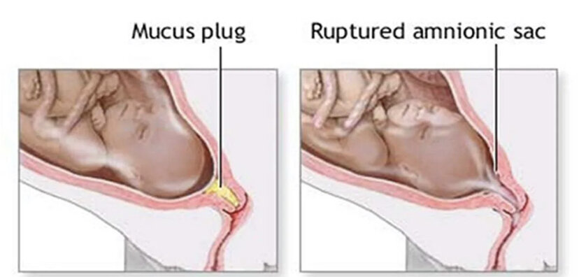 Слизистая пробка: как выглядит и что значит ее отхождение