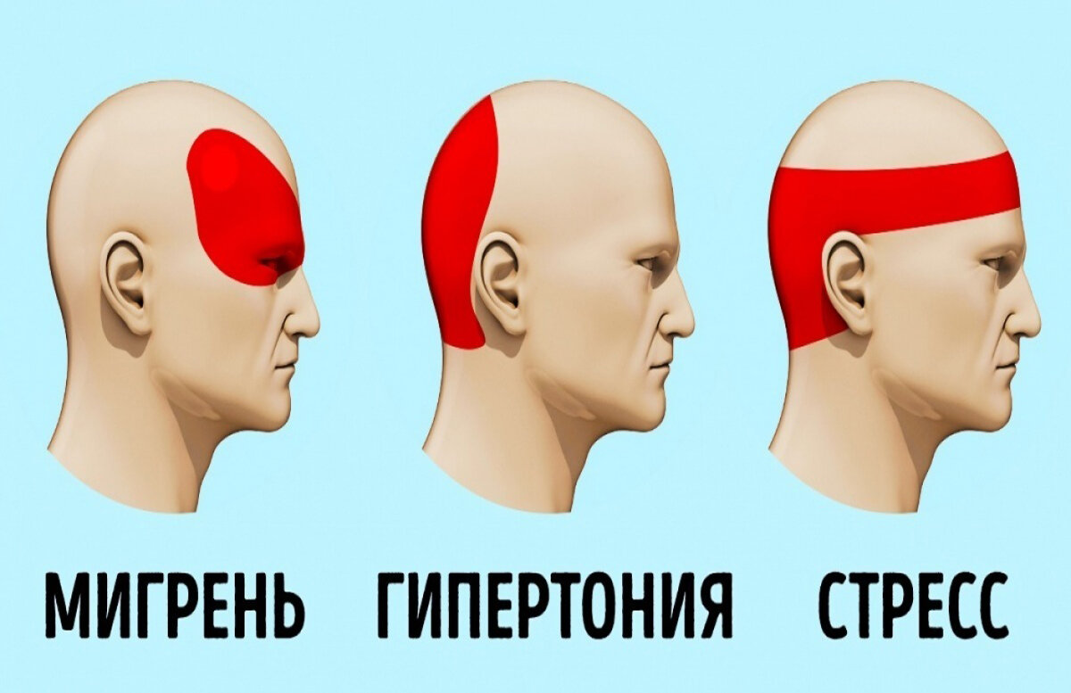 Раскалывается голова поэтому часто пьете лекарства без рецепта? Это вредно,  а что делать? | Рецепты здоровья мира | Дзен