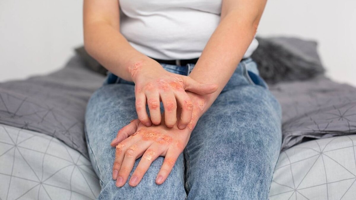 В Удмуртии более 96% случаев рака кожи выявляется на ранних стадиях