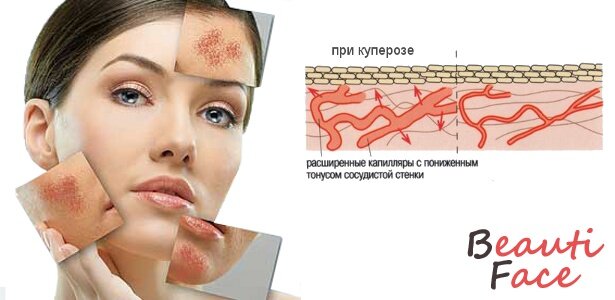 Как выглядят сосуды на лице ТОП средств борьбы с куперозом КРАСОТА И ЗДОРОВЬЕ Дзен